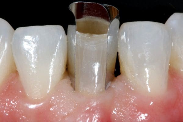 The New Fusion Anterior Matrix System: A Modern Approach to Anterior ...